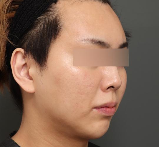 20代男性の顔の脂肪吸引  After 症例写真