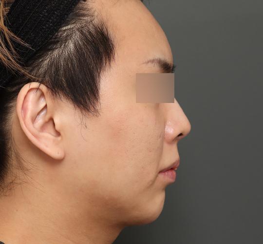 20代男性の顔の脂肪吸引  After 症例写真