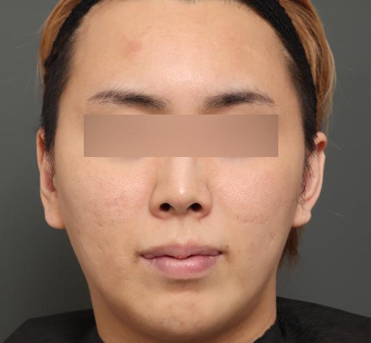 20代男性の顔の脂肪吸引 Before 症例写真
