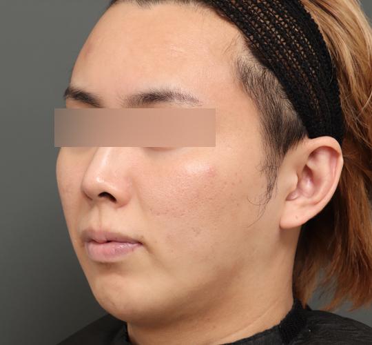 20代男性の顔の脂肪吸引  Before 症例写真