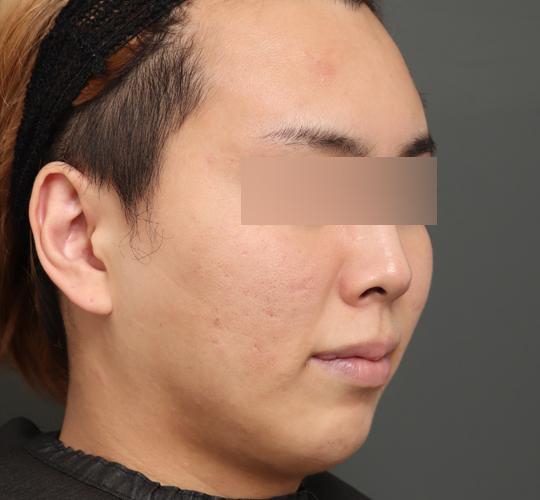 20代男性の顔の脂肪吸引  Before 症例写真