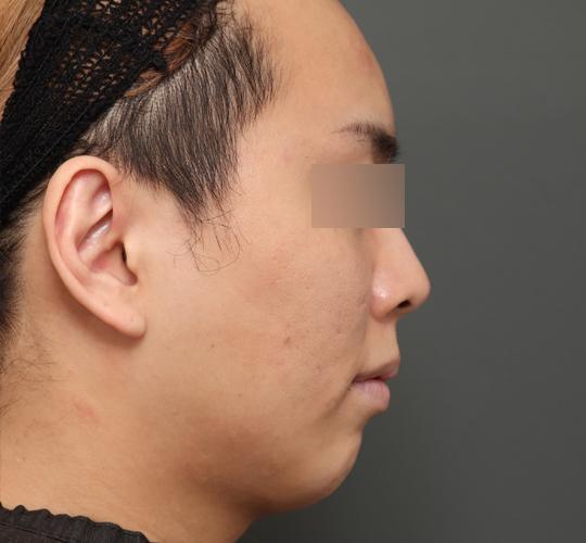 20代男性の顔の脂肪吸引  Before 症例写真