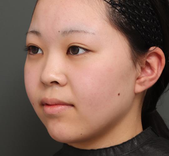 20代女性のバッカルファット除去 After 症例写真