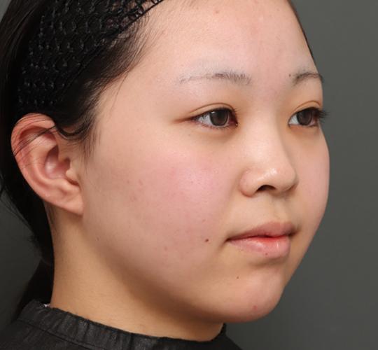 20代女性のボトックス(アゴ) After 症例写真