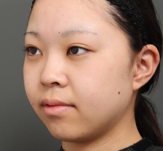 20代女性のバッカルファット除去 Before 症例写真