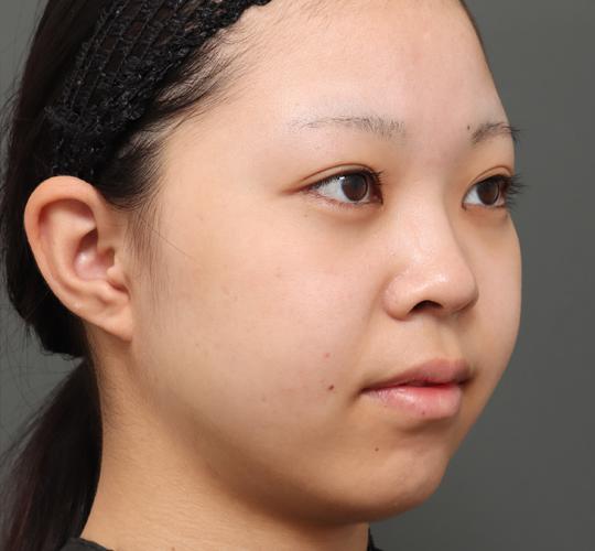 20代女性のボトックス(アゴ) Before 症例写真