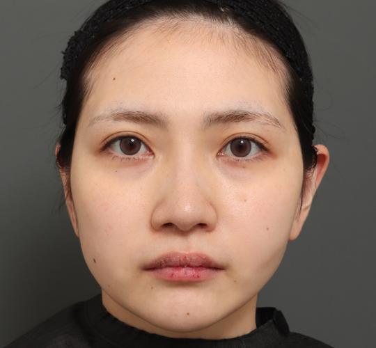 20代女性のバッカルファット除去 After 症例写真