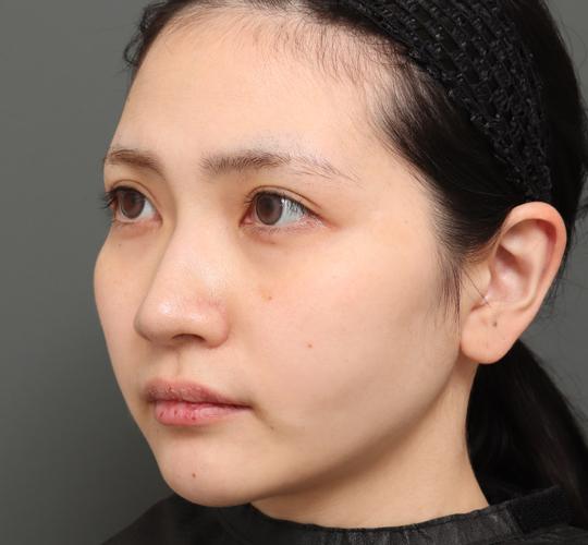 20代女性のバッカルファット除去 After 症例写真