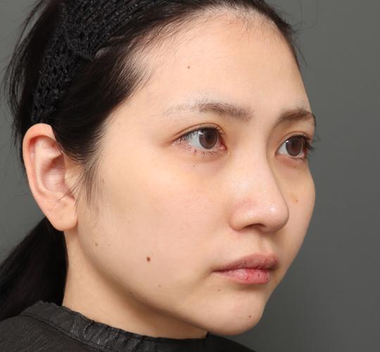 20代女性のバッカルファット除去 After 症例写真