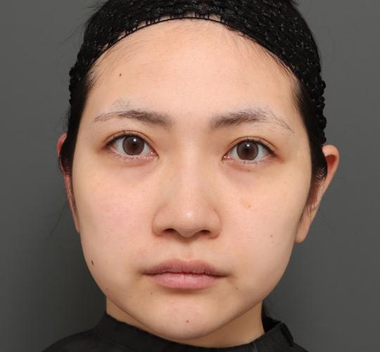 20代女性のバッカルファット除去 Before 症例写真