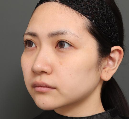 20代女性のバッカルファット除去 Before 症例写真