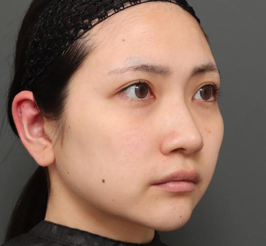 20代女性のバッカルファット除去 Before 症例写真