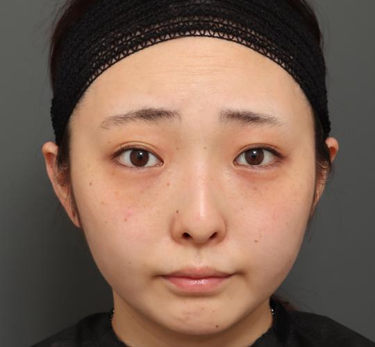 20代女性の顔の脂肪吸引 After 症例写真