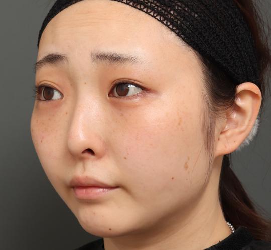 20代女性の顔の脂肪吸引  After 症例写真
