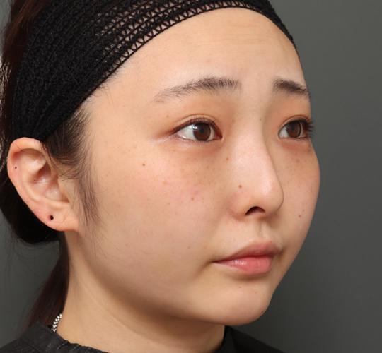 20代女性の顔の脂肪吸引  After 症例写真
