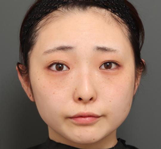 20代女性の顔の脂肪吸引 Before 症例写真