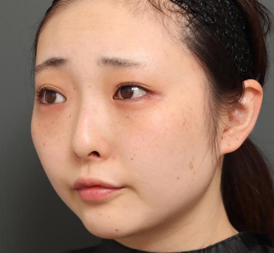 20代女性の顔の脂肪吸引  Before 症例写真