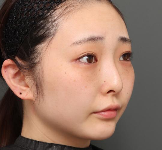 20代女性の顔の脂肪吸引  Before 症例写真