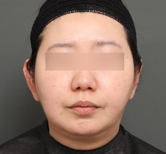 30代女性の顔の脂肪吸引 After 症例写真