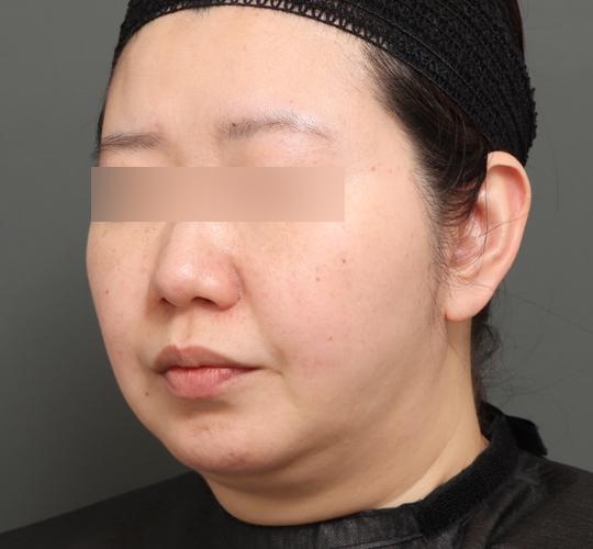 30代女性の顔の脂肪吸引  After 症例写真
