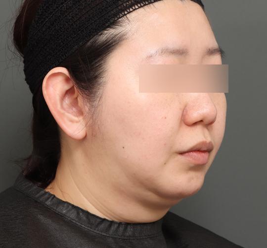 30代女性の顔の脂肪吸引  After 症例写真