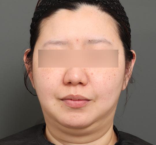 30代女性の顔の脂肪吸引 Before 症例写真