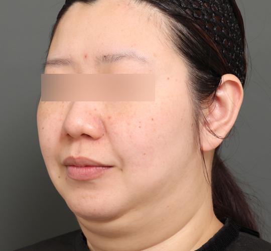 30代女性の顔の脂肪吸引  Before 症例写真