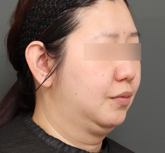 30代女性の顔の脂肪吸引  Before 症例写真