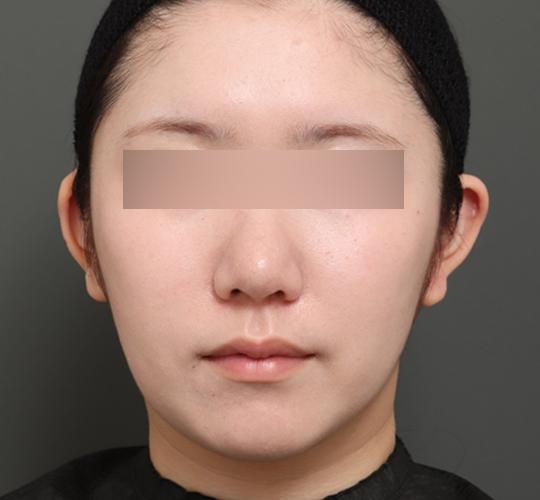 20代女性のバッカルファット除去 After 症例写真