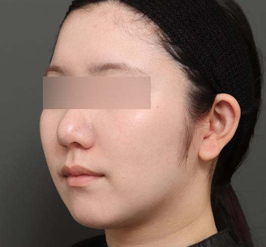 20代女性のバッカルファット除去 After 症例写真