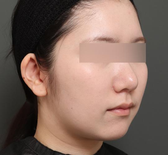 20代女性のボトックス(小顔) After 症例写真