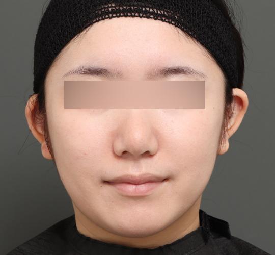 20代女性のバッカルファット除去 Before 症例写真