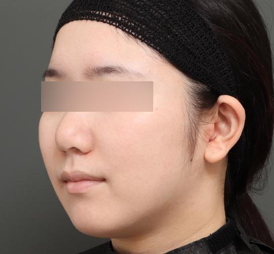 20代女性のバッカルファット除去 Before 症例写真