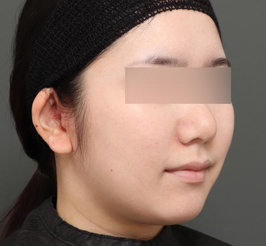 20代女性のボトックス(小顔) Before 症例写真