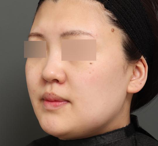 20代女性のバッカルファット除去 After 症例写真