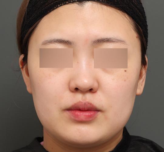 20代女性のバッカルファット除去 Before 症例写真