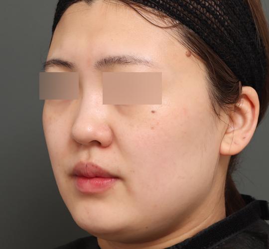 20代女性のバッカルファット除去 Before 症例写真
