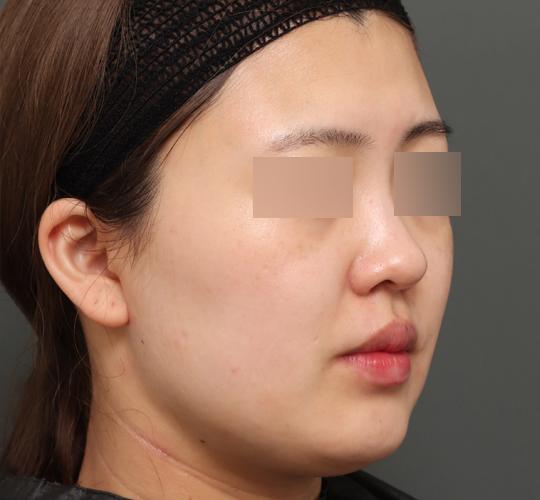 20代女性のバッカルファット除去 Before 症例写真