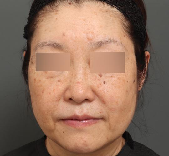 60代女性のアルテミスリフト After 症例写真