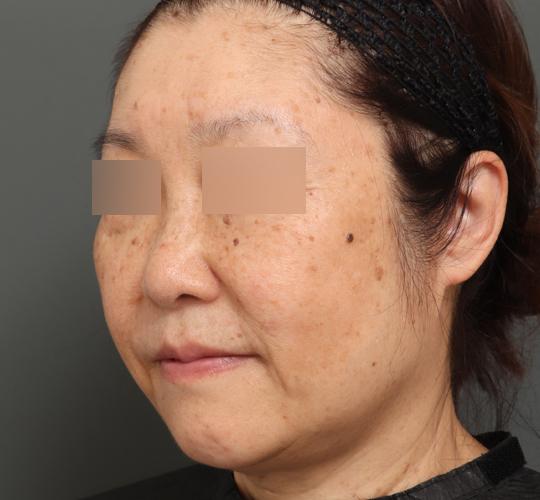 60代女性のアルテミスリフト After 症例写真