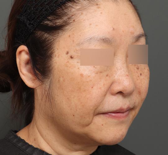 60代女性のアルテミスリフト After 症例写真