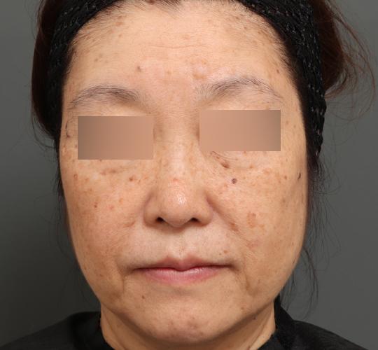 60代女性のアルテミスリフト Before 症例写真