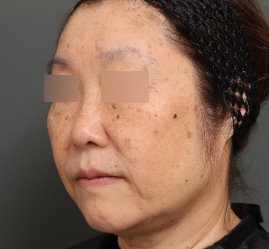 60代女性のアルテミスリフト Before 症例写真