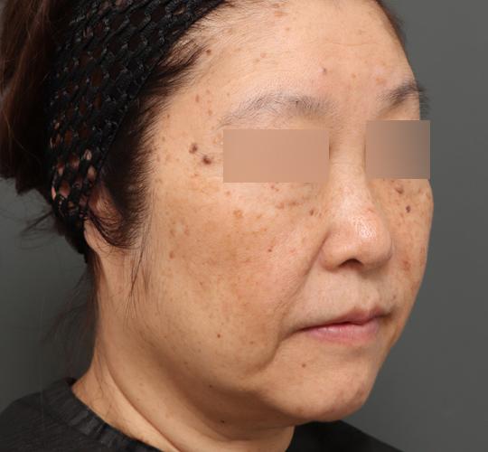 60代女性のアルテミスリフト Before 症例写真