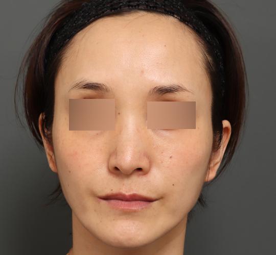 40代女性のボルニューマー After 症例写真