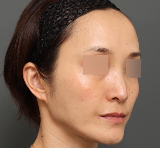 40代女性のボルニューマー After 症例写真