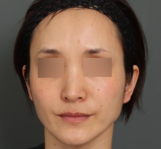 40代女性のボルニューマー Before 症例写真