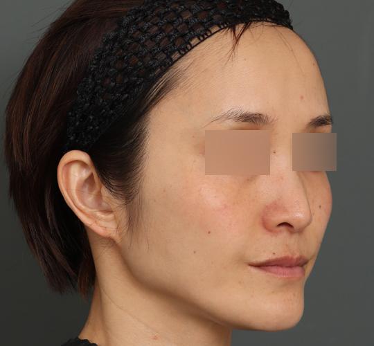 40代女性のボルニューマー Before 症例写真