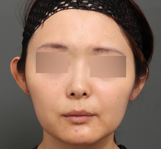 30代女性のボルニューマー After 症例写真