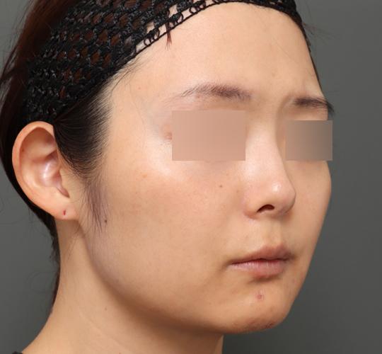 30代女性のボルニューマー After 症例写真